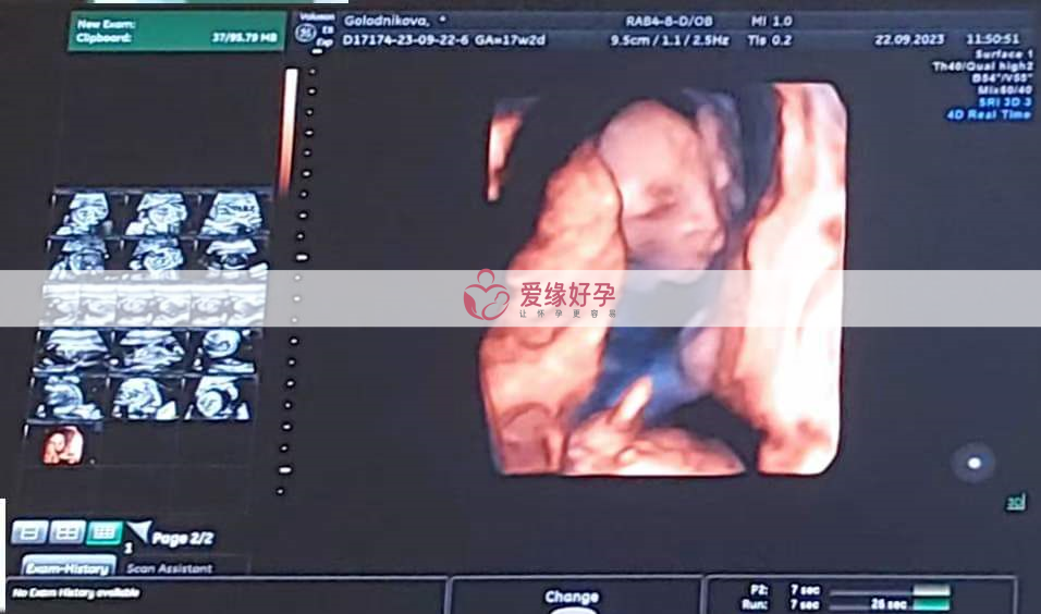 台湾委托父母同卵双胞胎17周检查顺利通过！