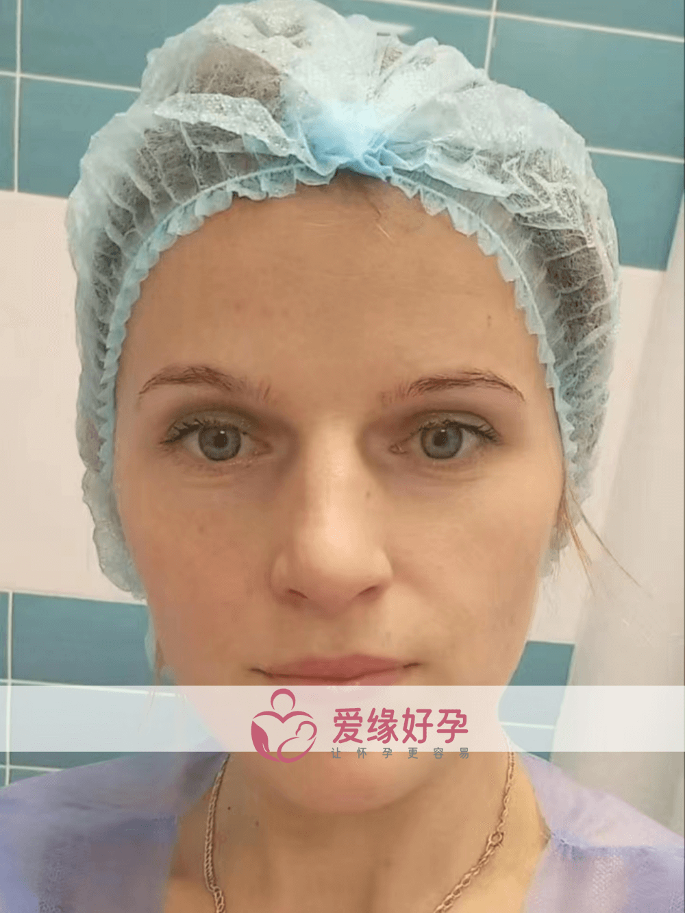 乌克兰代孕孕母1月5日在乌克兰MC医院移植一颗囊胚