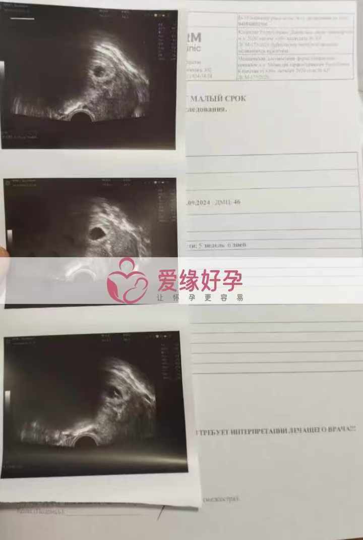 格鲁吉亚爱心使者孕6周产检顺利通过
