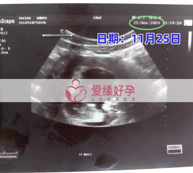 格鲁吉亚爱心使者孕12周产检顺利通过