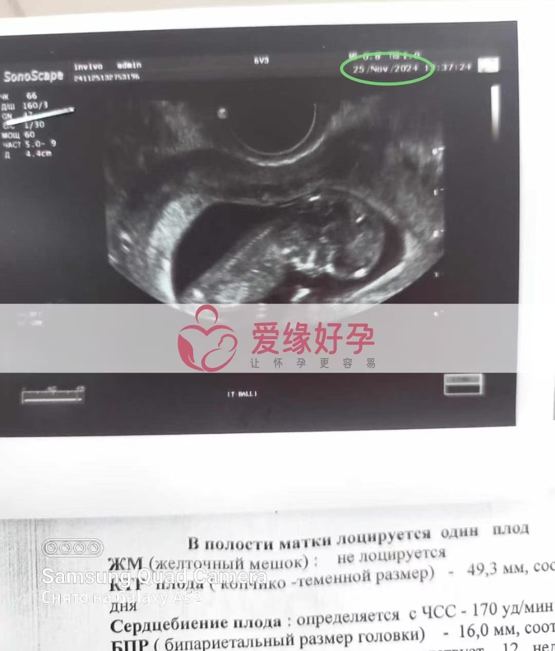 格鲁吉亚爱心使者孕12周产检顺利通过