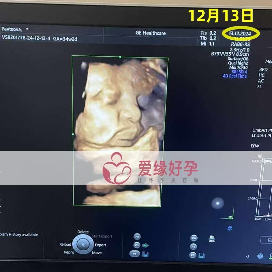 乌克兰爱心使者孕34周产检顺利通过