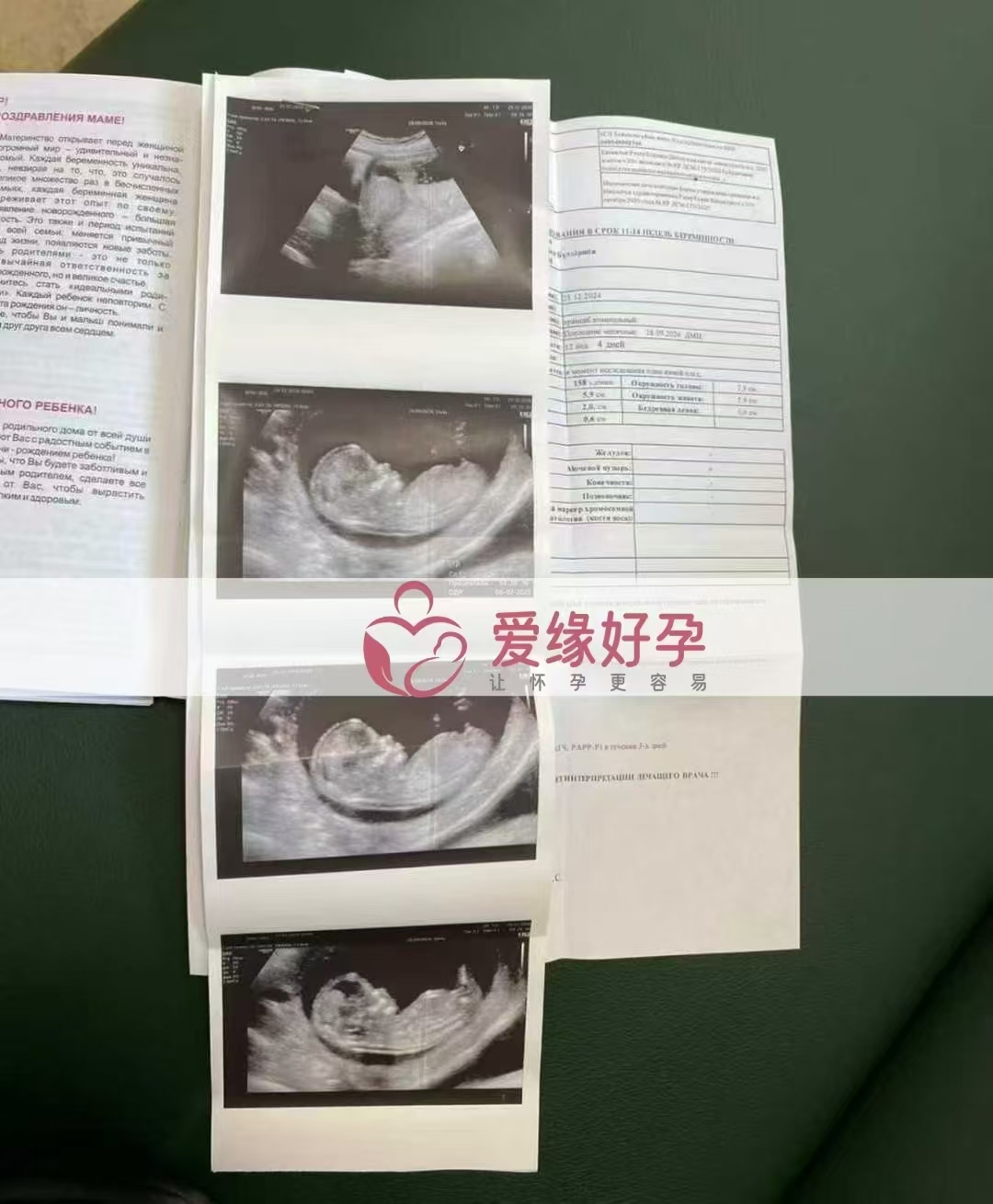 哈萨克斯坦爱心使者孕12周NT产检顺利通过