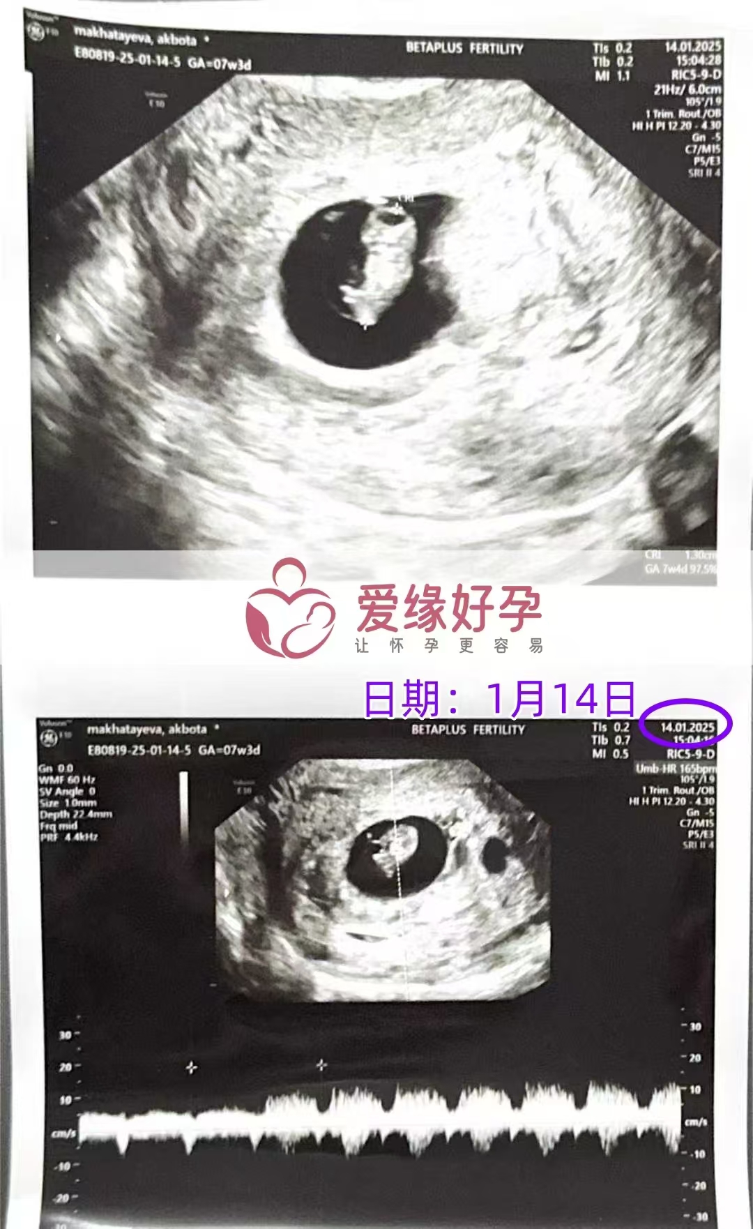 格鲁吉亚爱心使者孕7周产检顺利通过