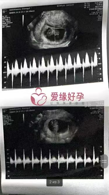 格鲁吉亚爱心使者双胞胎孕9周产检顺利通过