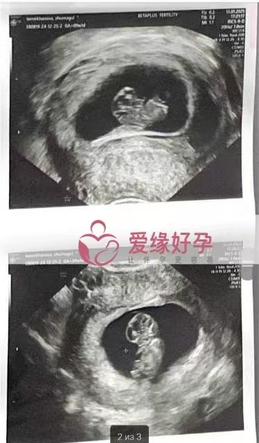 格鲁吉亚爱心使者双胞胎孕9周产检顺利通过