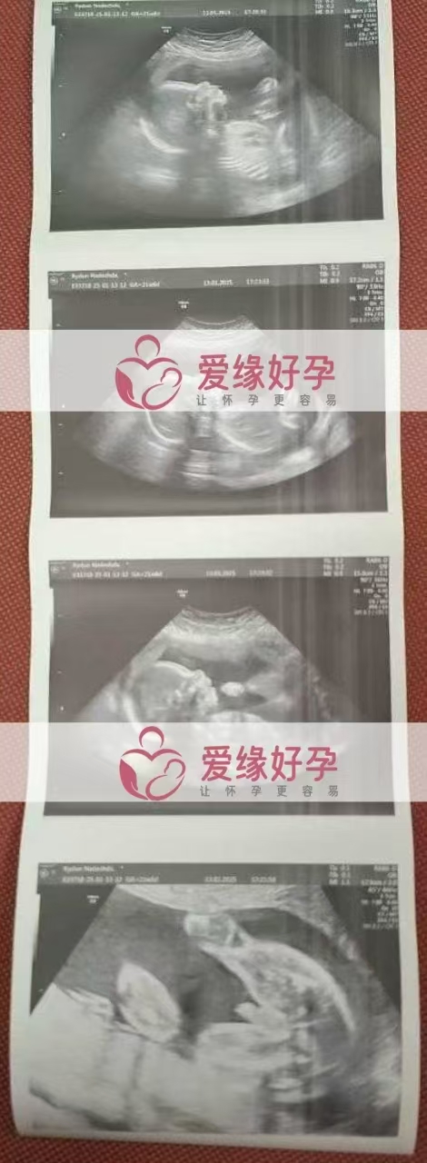 格鲁吉亚爱心使者孕21周产检顺利通过