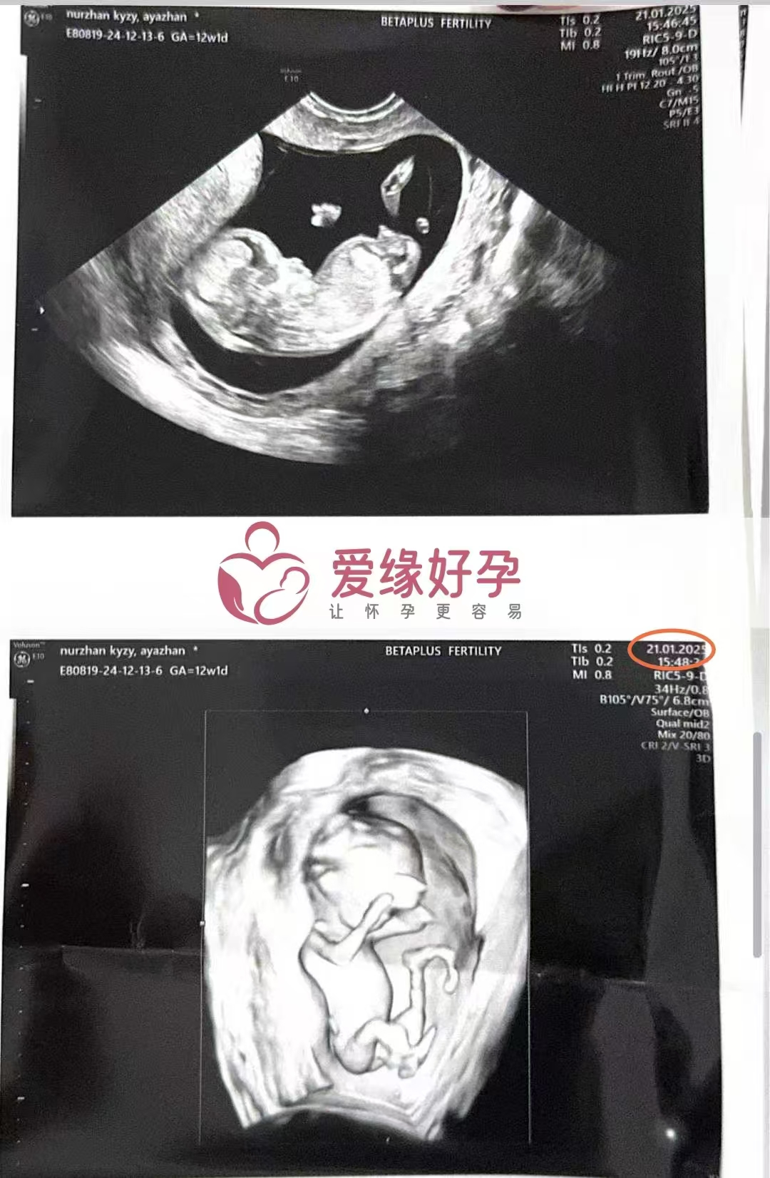 格鲁吉亚爱心使者顺利通过12周孕检，正式进入稳定期！