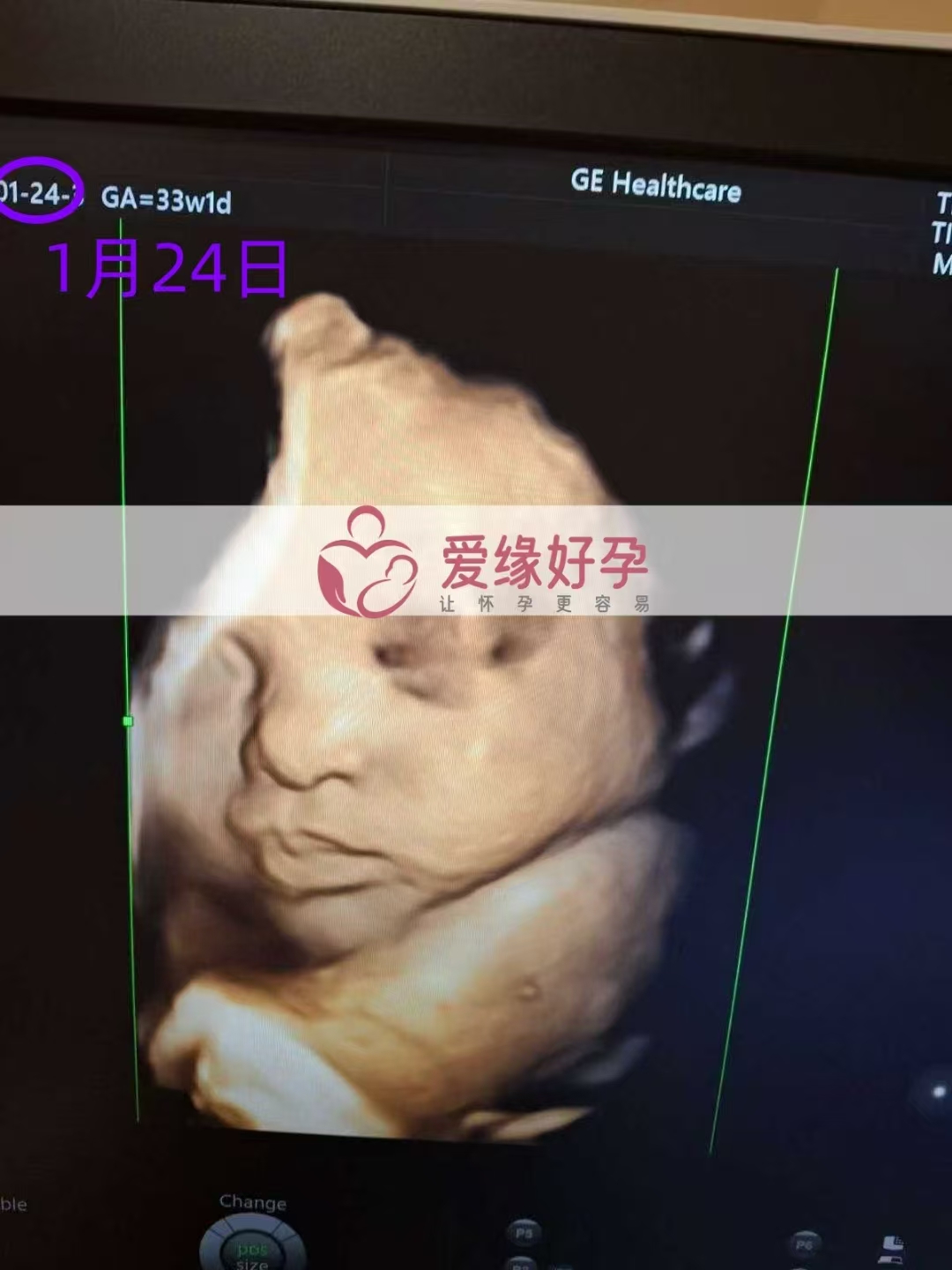 乌克兰试管婴儿助孕爱心使者33周产检顺利通过