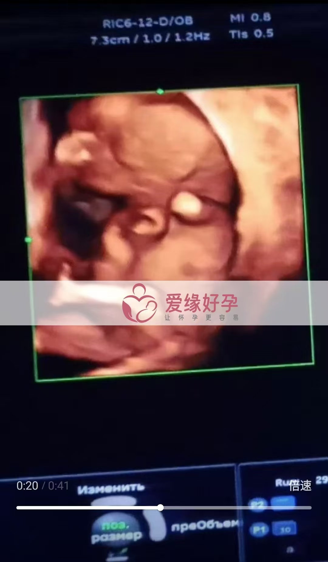乌克兰试管婴儿助孕爱心使者跨越国界，喜迎新生命