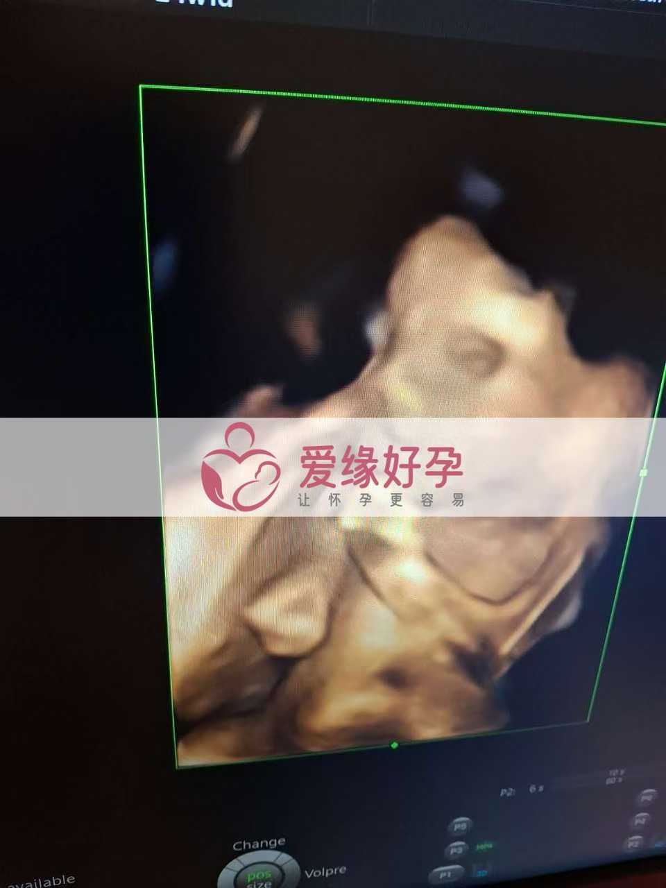乌克兰试管婴儿助孕爱心使者24周产检顺利通过
