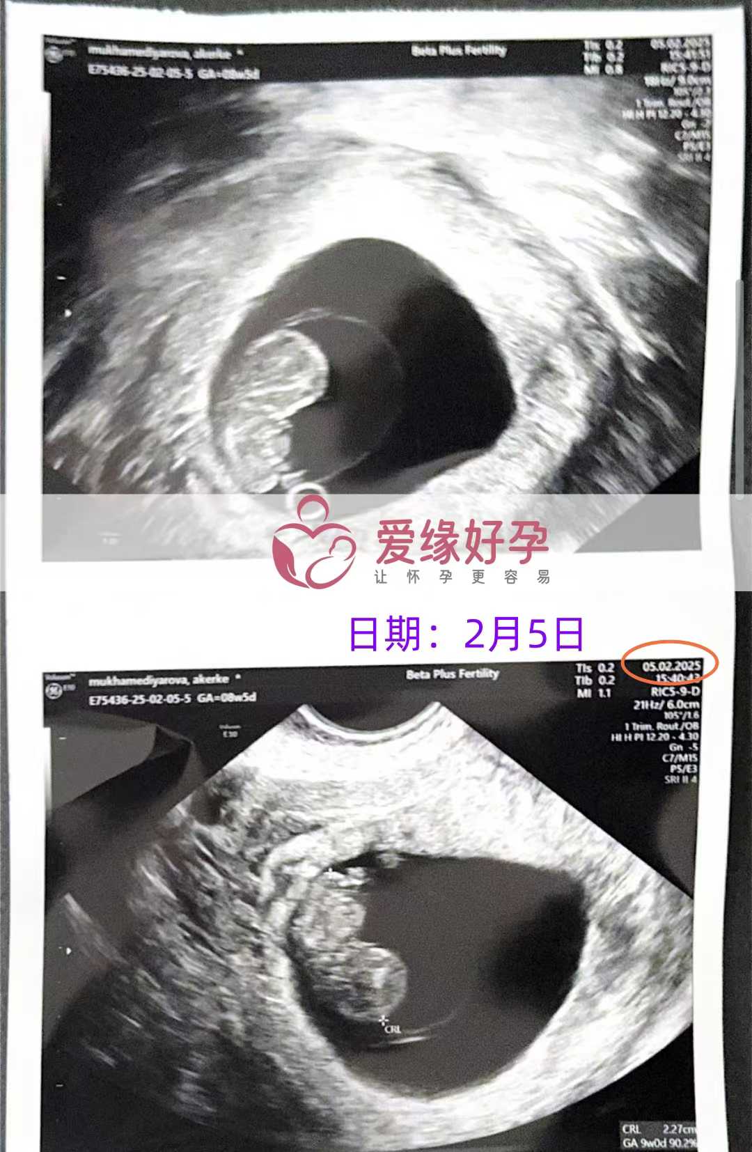 格鲁吉亚试管婴儿助孕爱心使者8周产检进展顺利