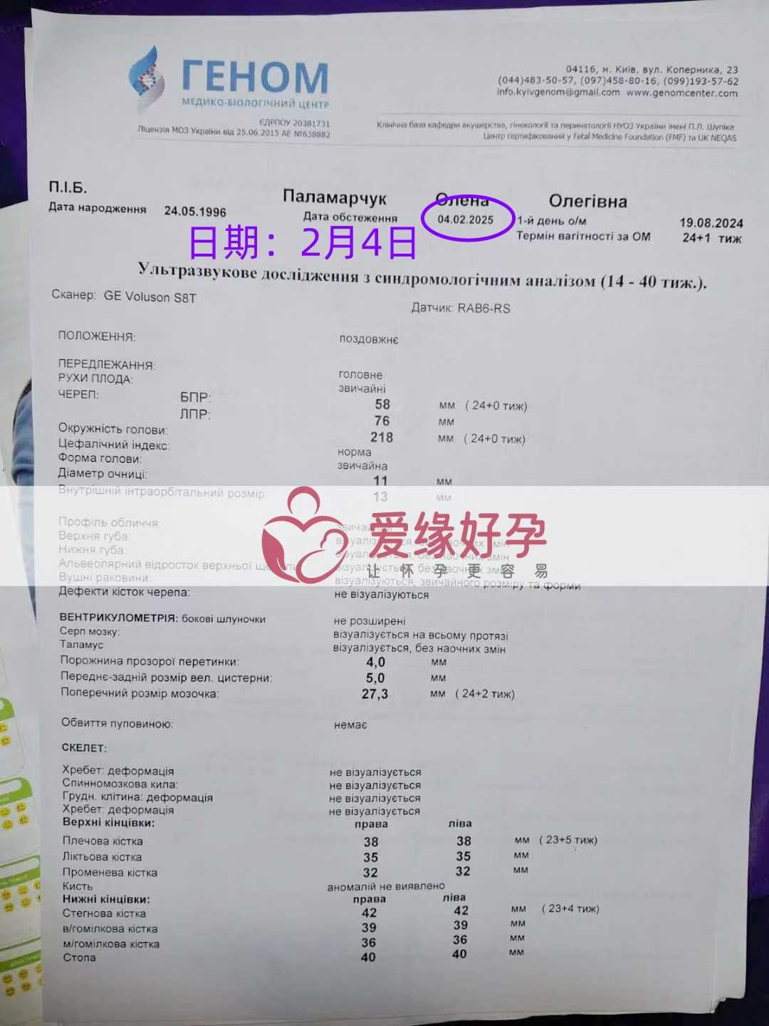 乌克兰试管婴儿助孕爱心使者24周产检顺利通过