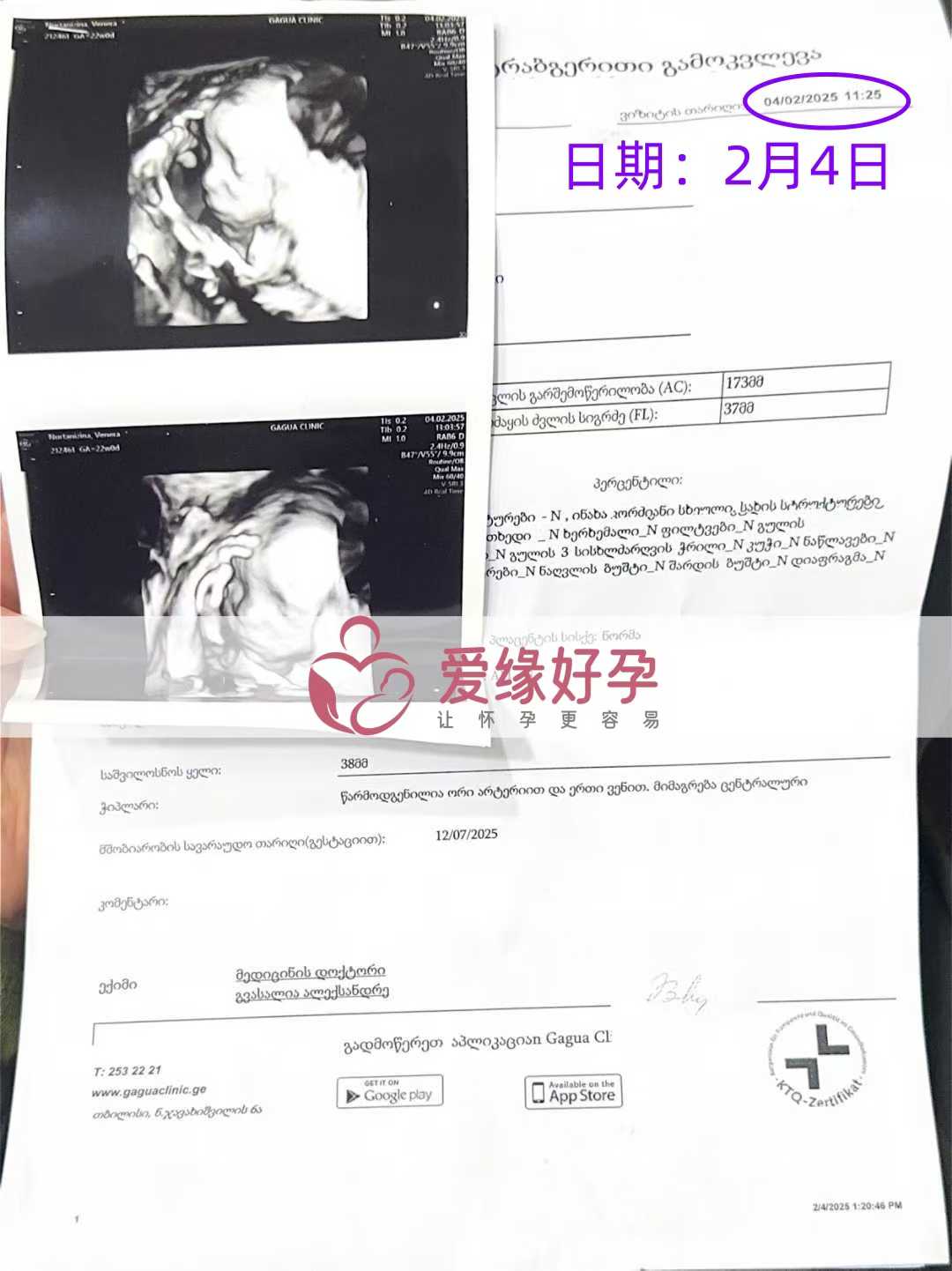 格鲁吉亚试管婴儿助孕爱心使者顺利通过21周产检