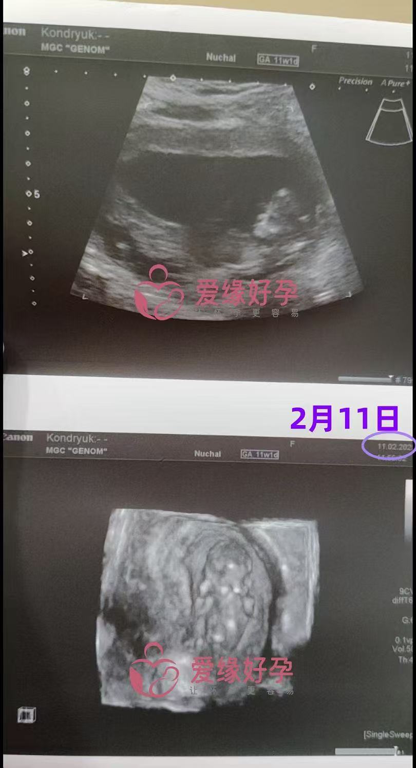 格鲁吉亚试管婴儿助孕爱心使者11周产检顺利通过