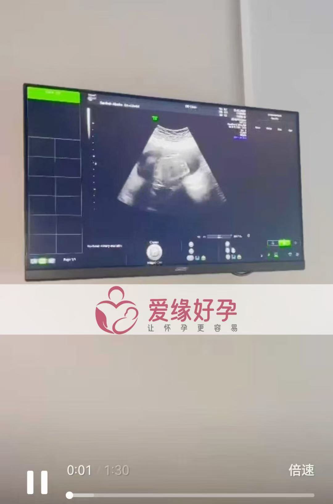 格鲁吉亚试管婴儿助孕爱心使者18周产检顺利通过