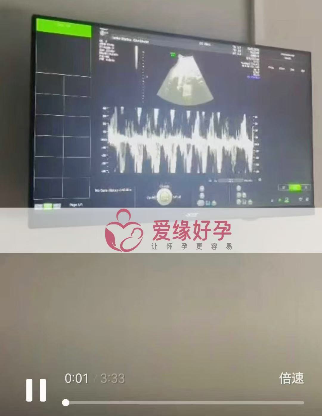 格鲁吉亚试管婴儿助孕爱心使者即将迎接新生命诞生