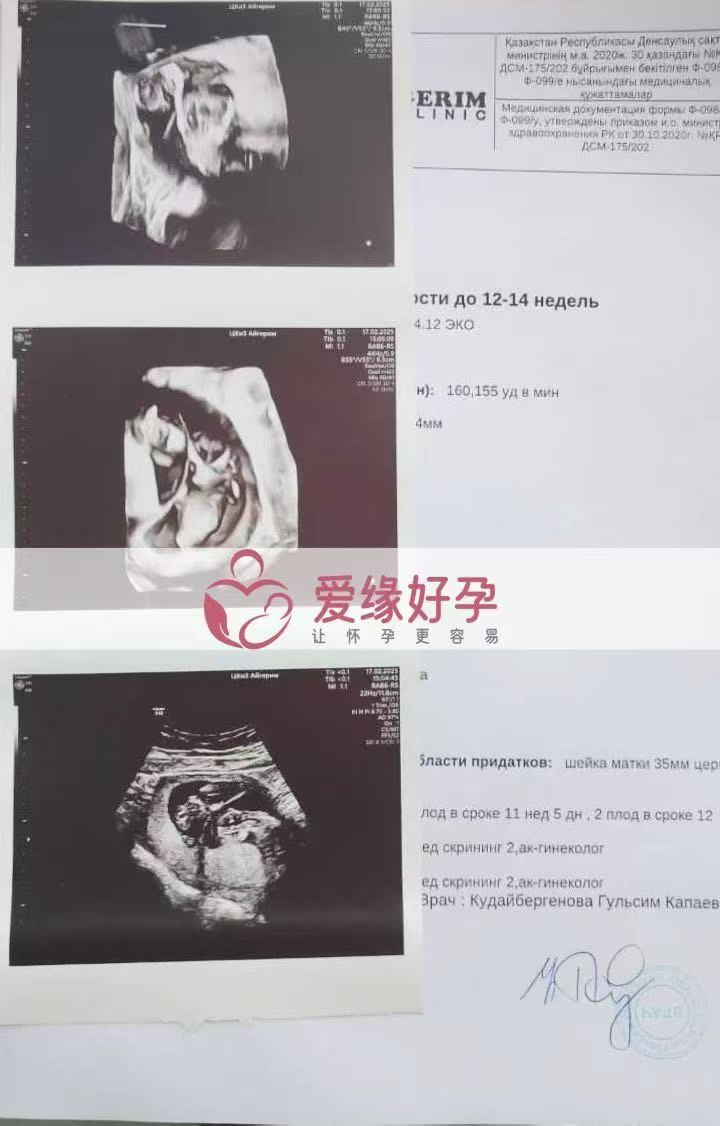 格鲁吉亚试管婴儿助孕双胎爱心使者12周产检顺利通过