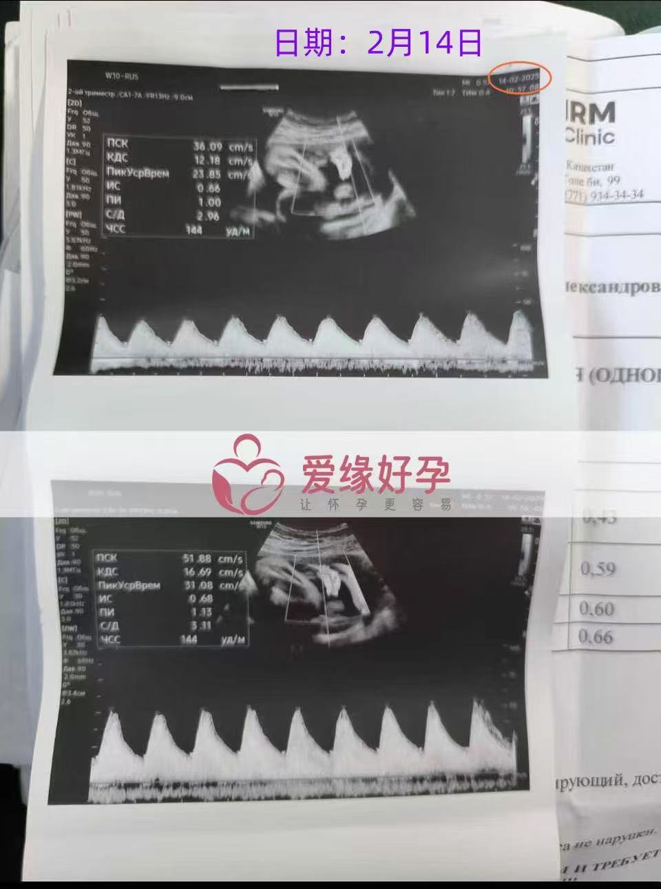 哈萨克斯坦试管婴儿助孕爱心使者32周产检顺利通过