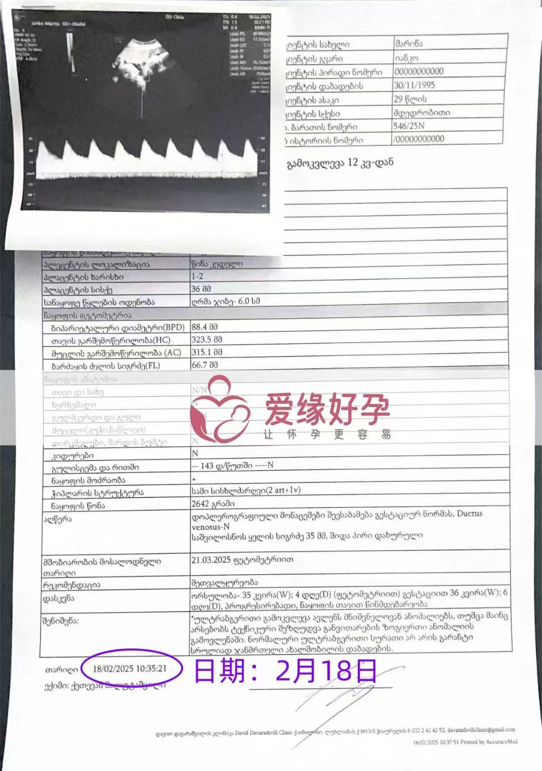 格鲁吉亚试管婴儿助孕爱心使者即将迎接新生命诞生