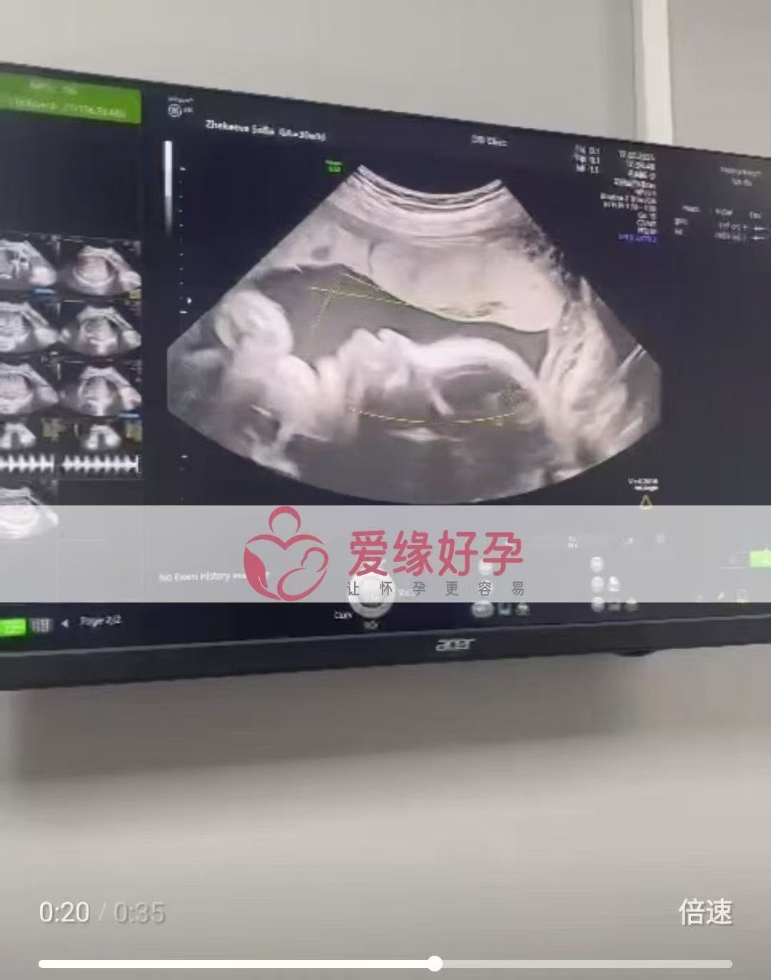 格鲁吉亚试管婴儿助孕爱心使者30周产检顺利通过