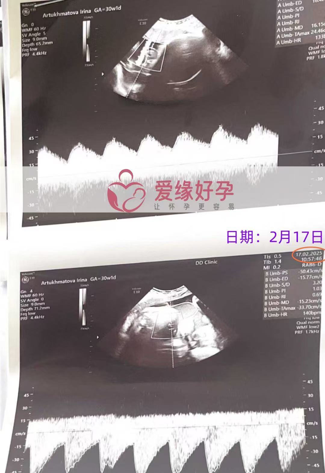 格鲁吉亚试管婴儿助孕爱心使者顺利完成30周产检
