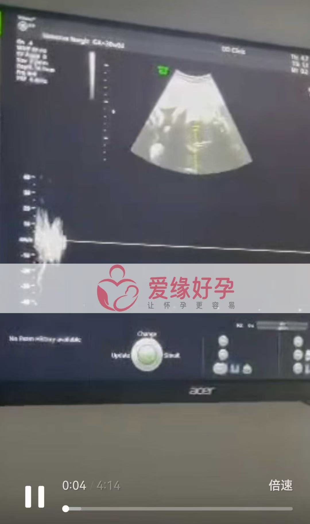 格鲁吉亚试管婴儿助孕爱心使者30周产检顺利通过