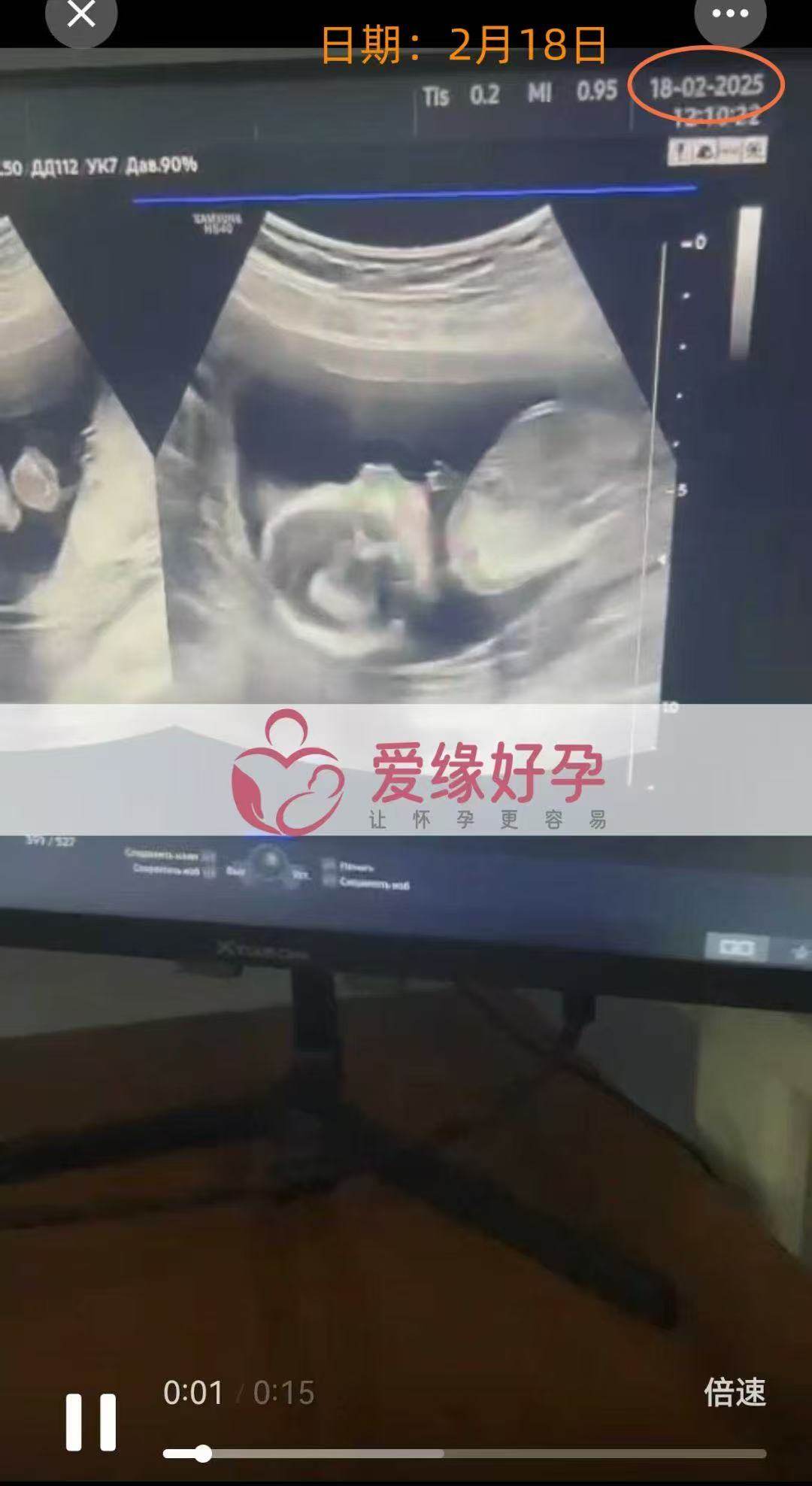 格鲁吉亚试管婴儿助孕爱心使者15周产检顺利通过