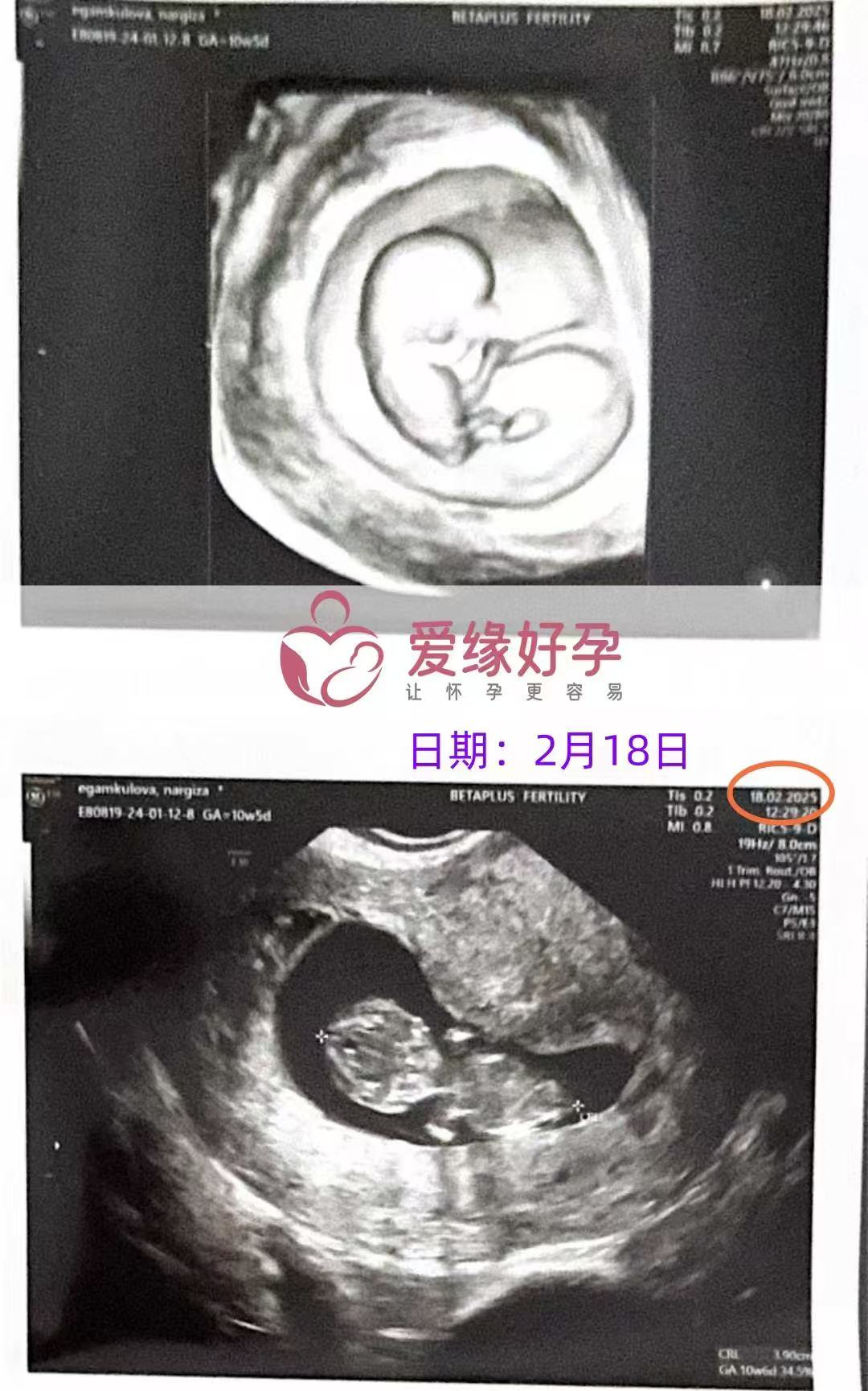 格鲁吉亚试管婴儿助孕爱心使者10周产检顺利通过