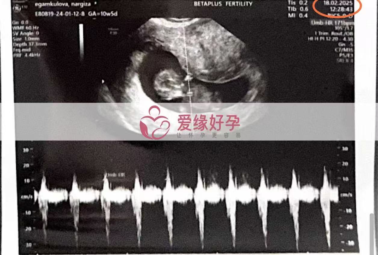 格鲁吉亚试管婴儿助孕爱心使者10周产检顺利通过