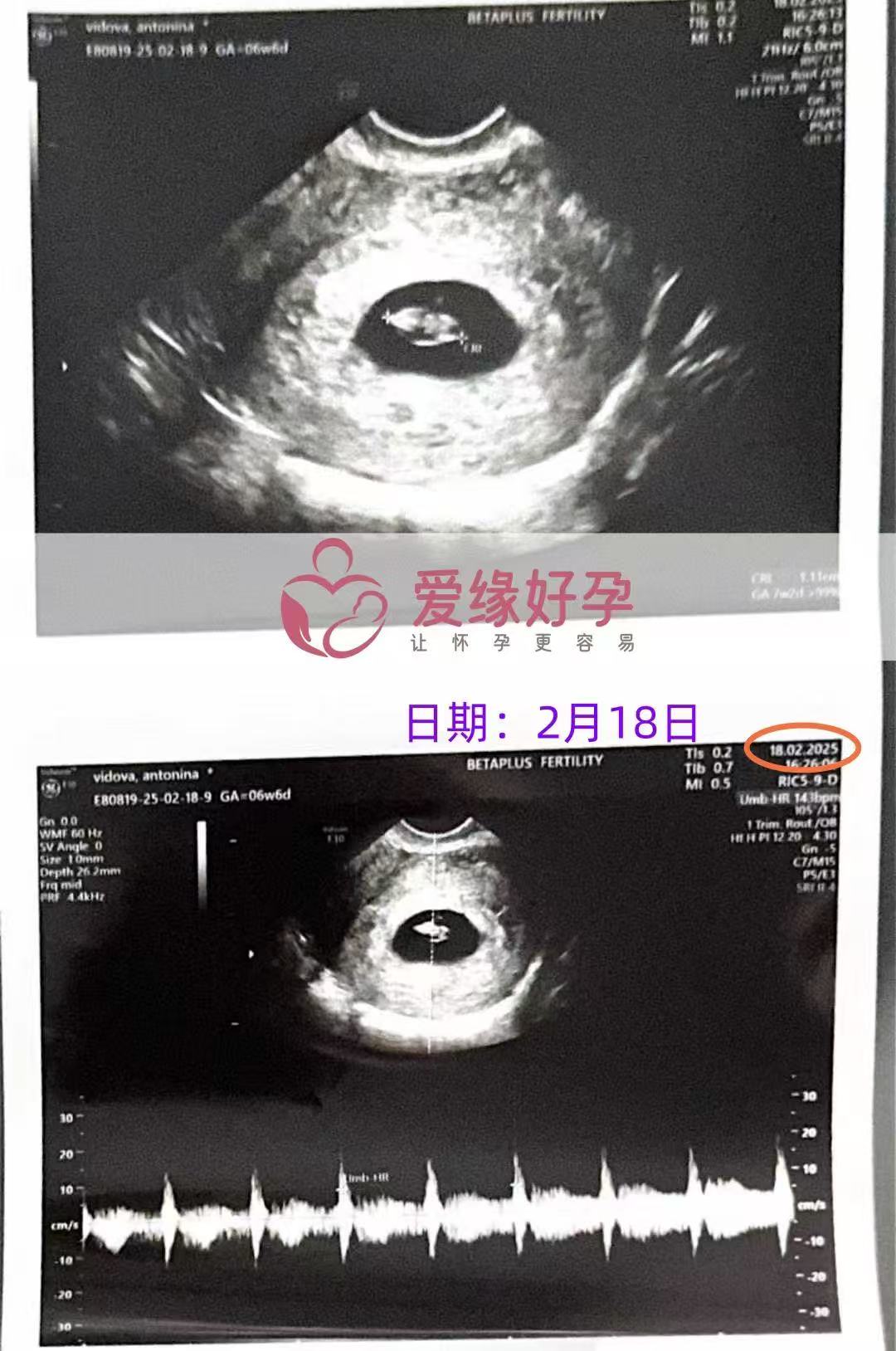 格鲁吉亚试管婴儿助孕爱心使者6周第一次产检完美通过