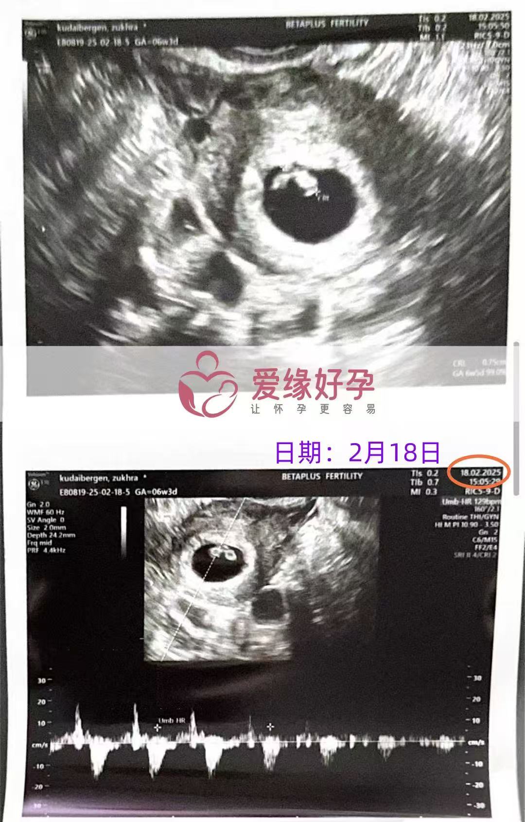 格鲁吉亚试管婴儿助孕爱心使者6周产检通过，孕期迈出第一步