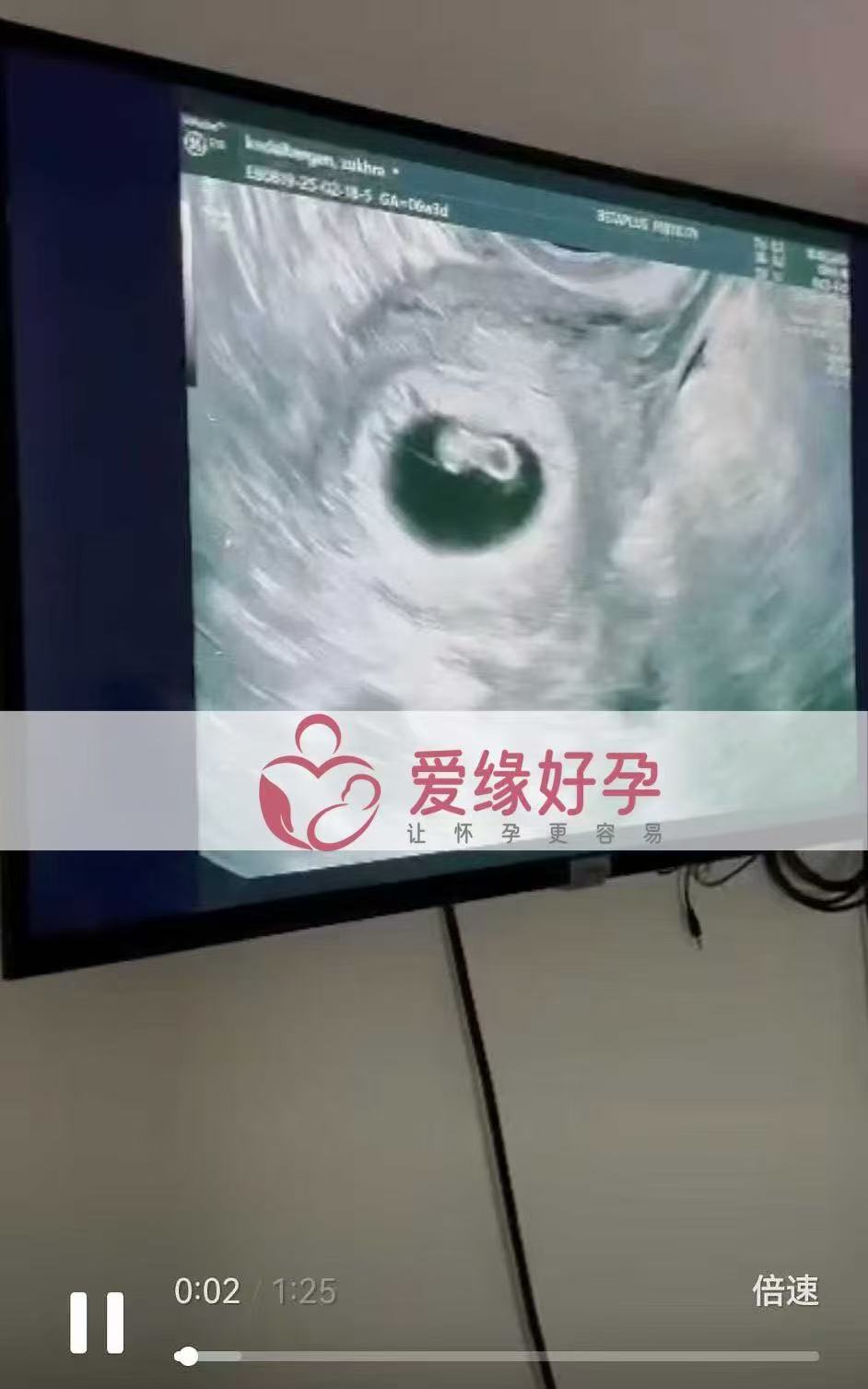 格鲁吉亚试管婴儿助孕爱心使者6周产检通过，孕期迈出第一步