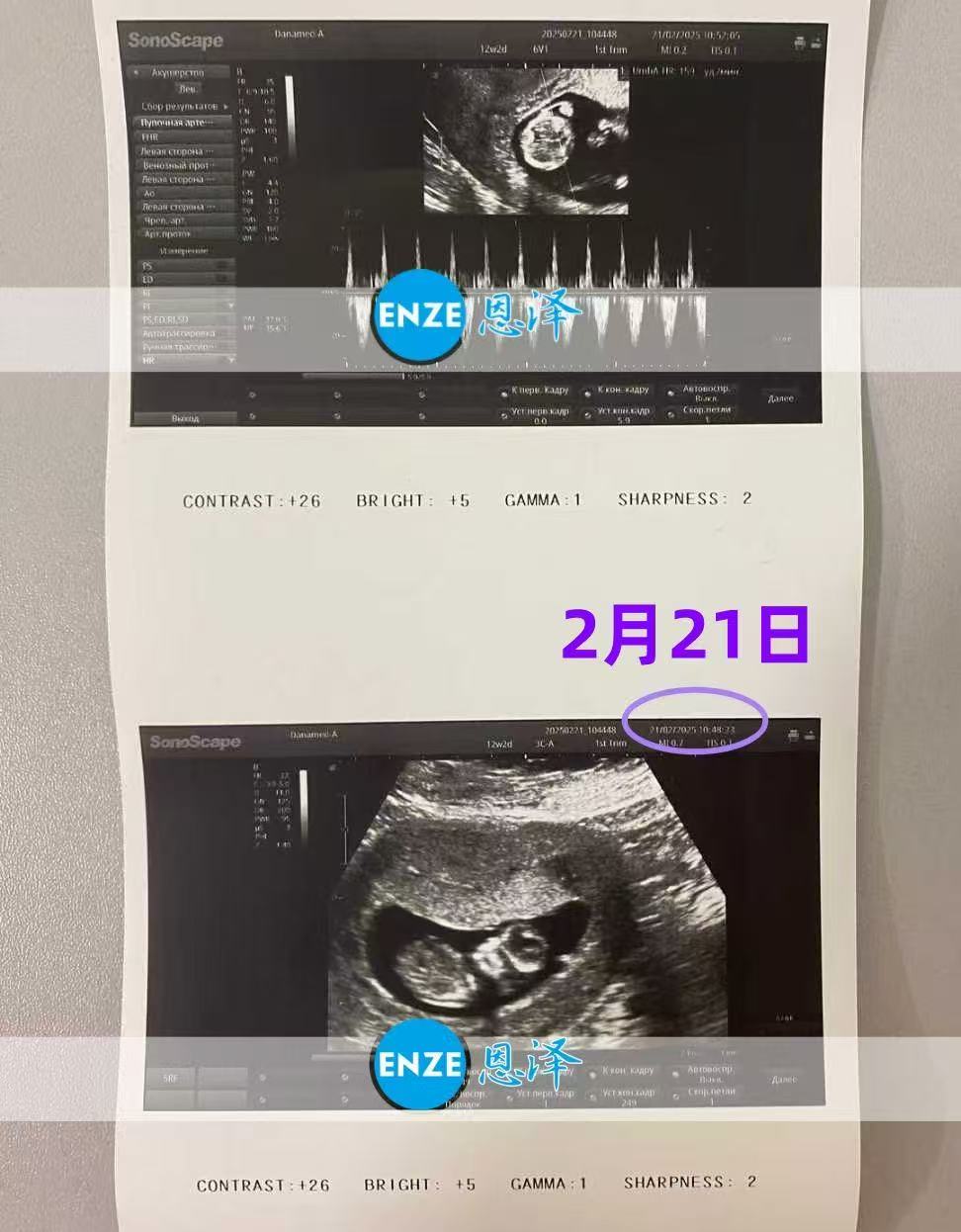 格鲁吉亚试管婴儿助孕爱心使者12周检查通过，迎来稳定期