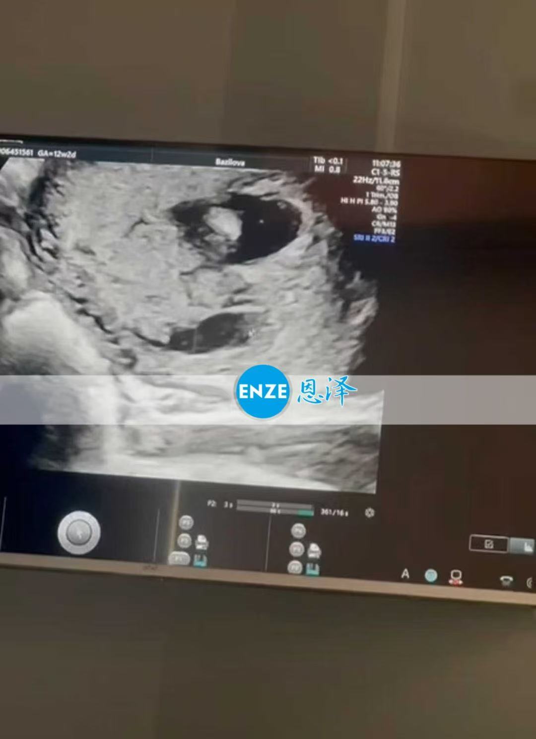 格鲁吉亚试管婴儿助孕爱心使者顺利通过12周检查，正式进入稳定期