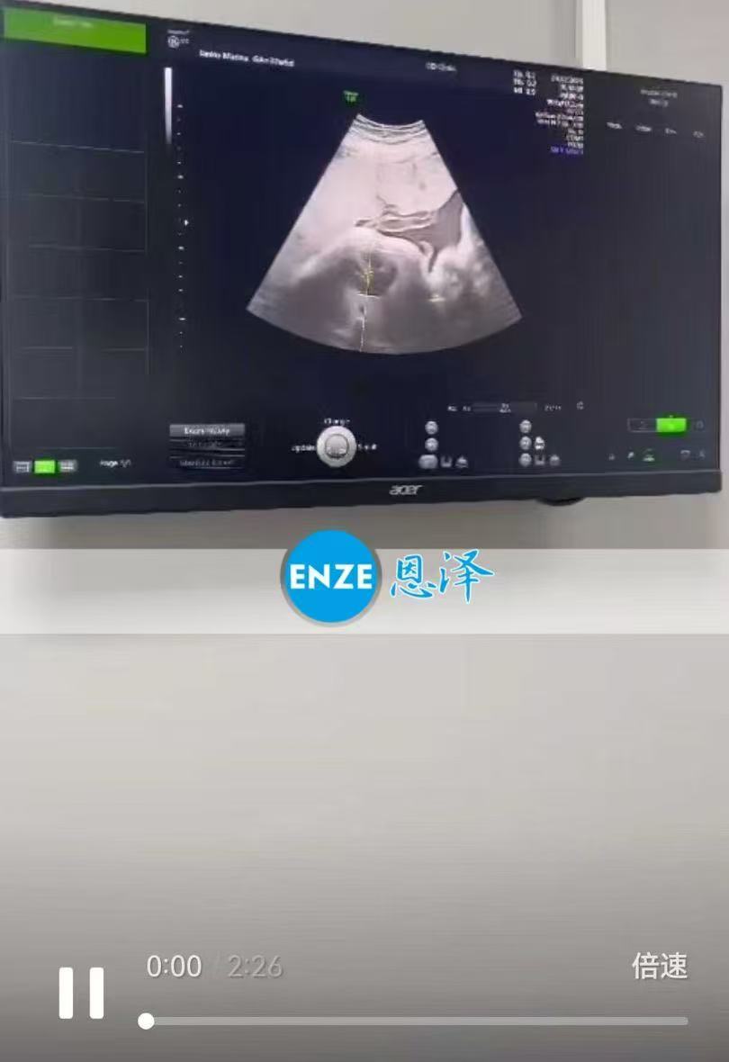 格鲁吉亚试管婴儿助孕爱心使者37周产检顺利，静待宝宝到来