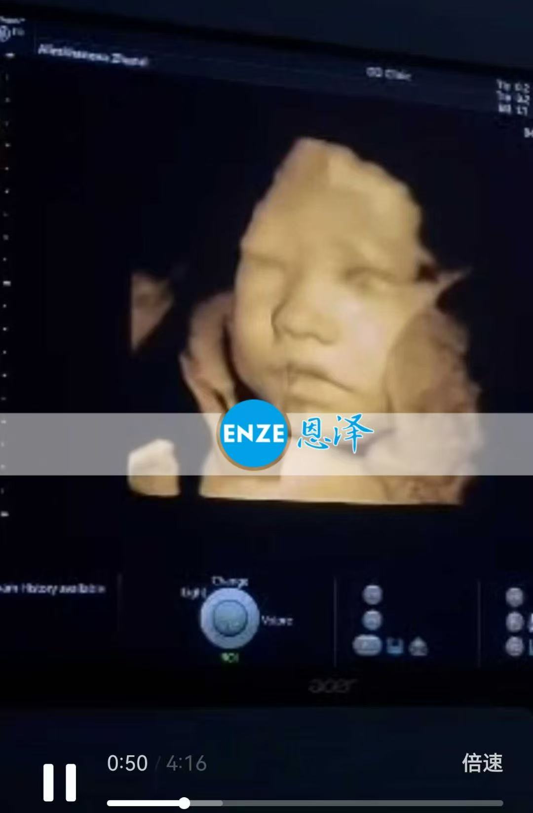 格鲁吉亚试管婴儿助孕爱心使者27周产检顺利通过