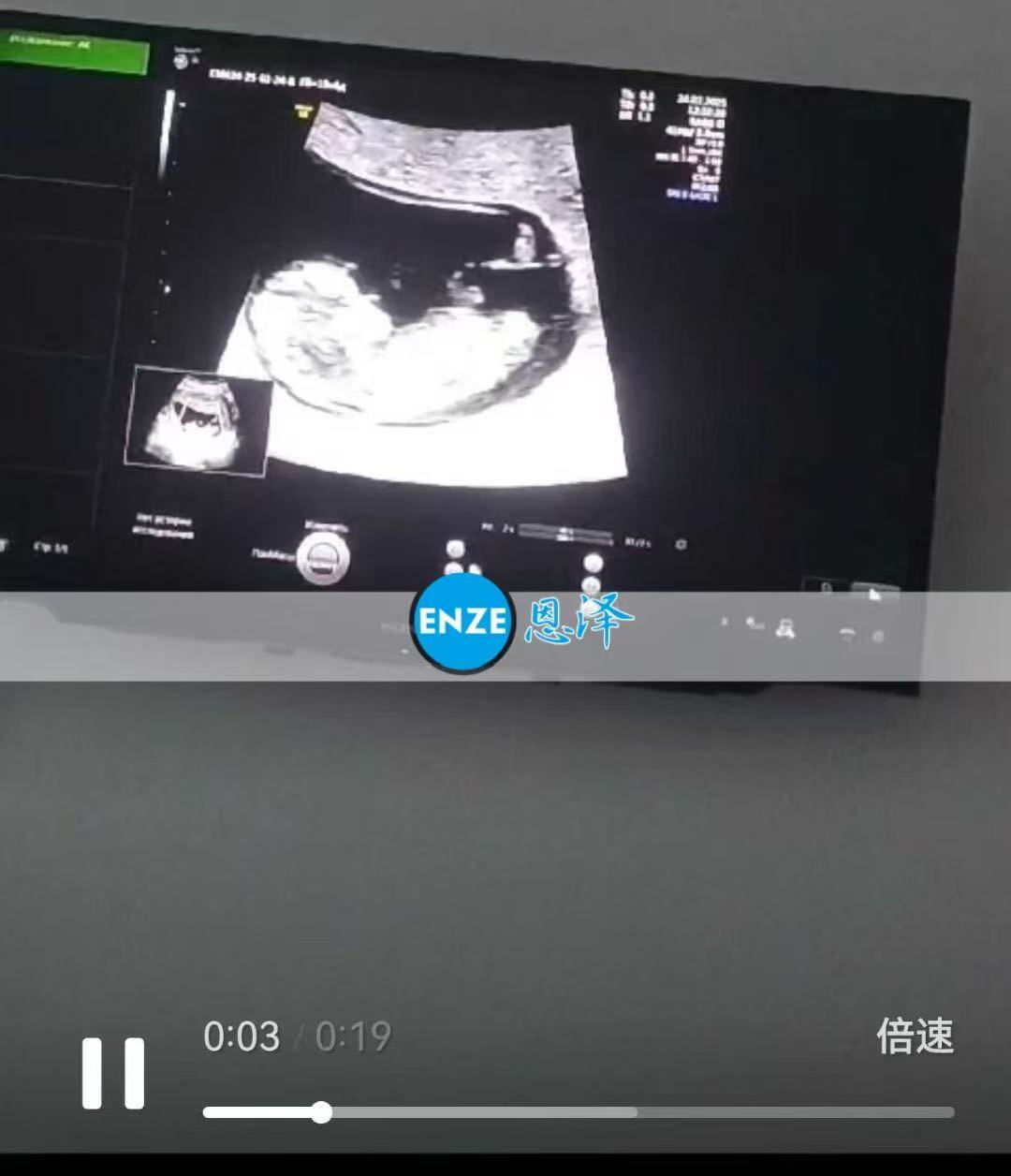 格鲁吉亚试管婴儿助孕爱心使者12周产检通过，顺利进入平稳期