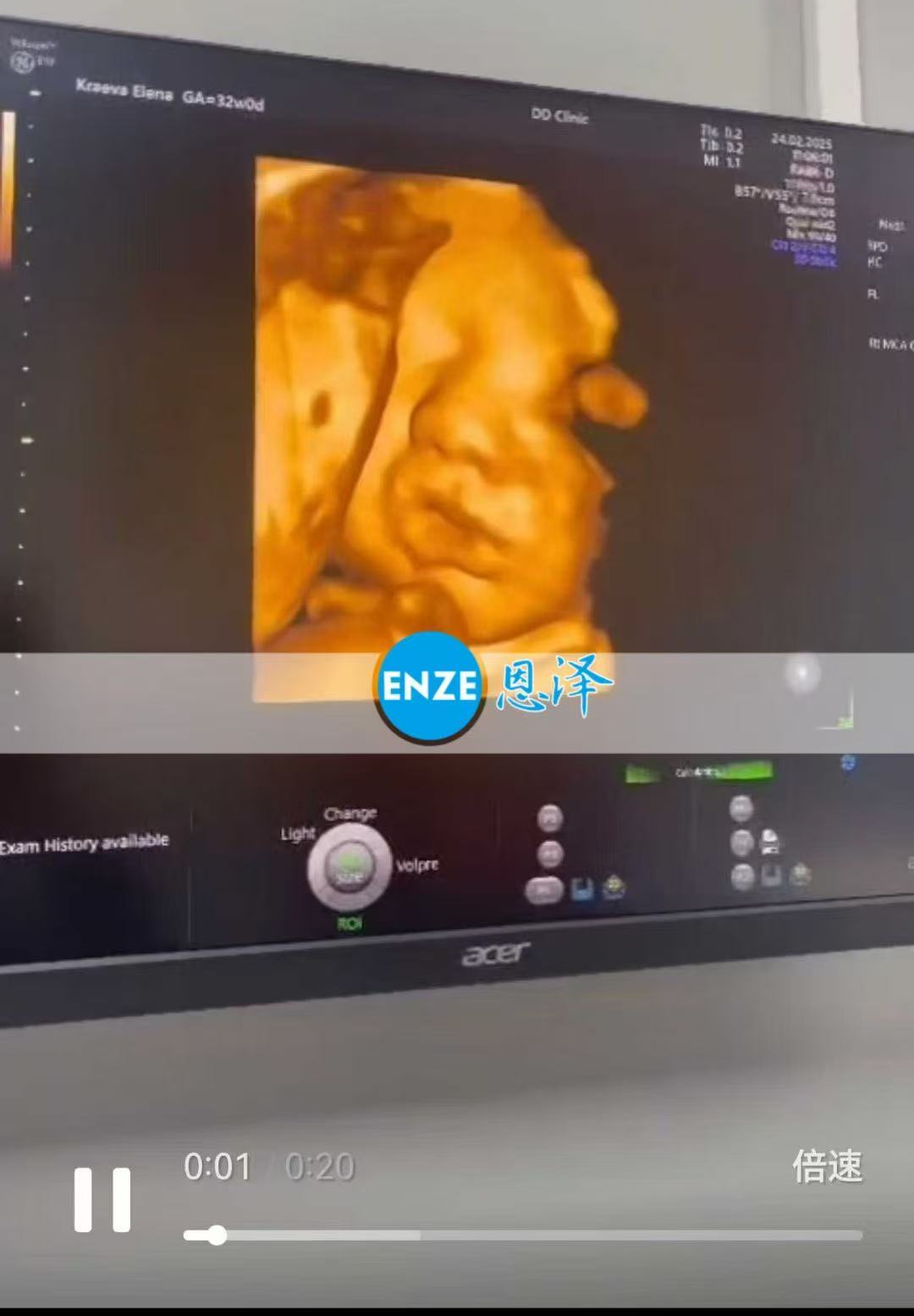 格鲁吉亚试管婴儿助孕爱心使者32周产检顺利通过