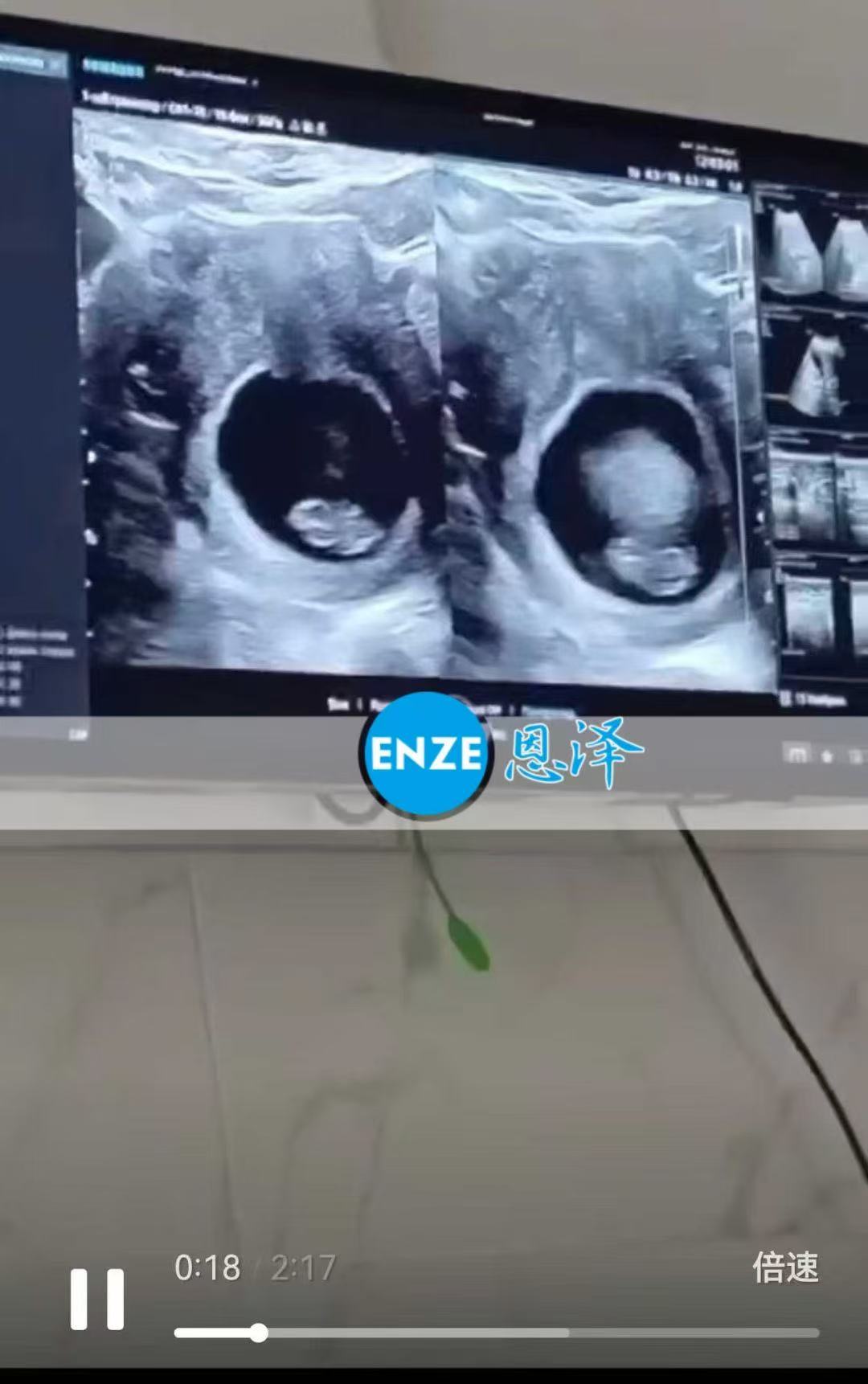 格鲁吉亚试管婴儿助孕爱心使者8周+4天产检顺利通过