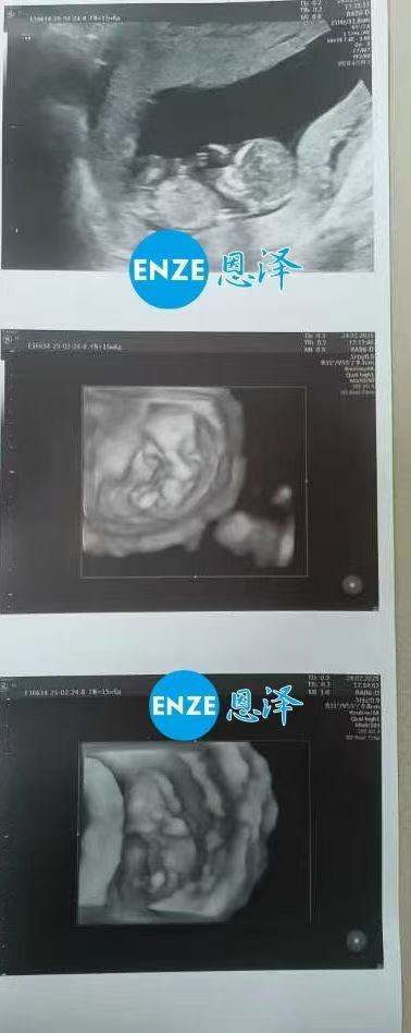 格鲁吉亚试管婴儿助孕爱心使者12周产检通过，顺利进入平稳期