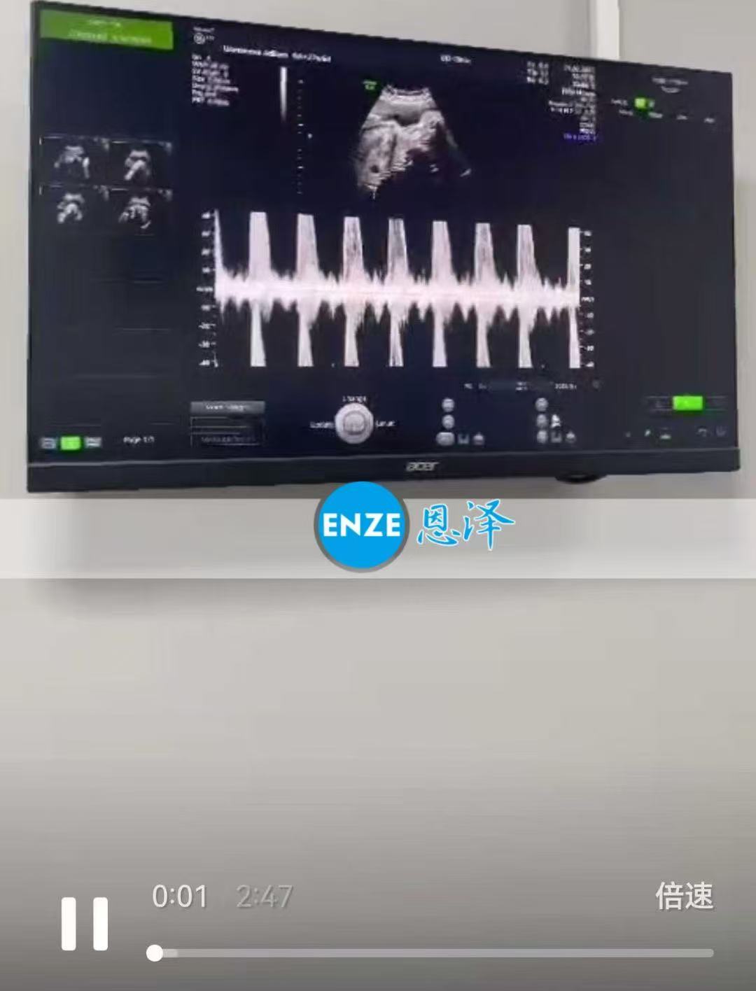 格鲁吉亚试管婴儿助孕爱心使者27周产检顺利通过