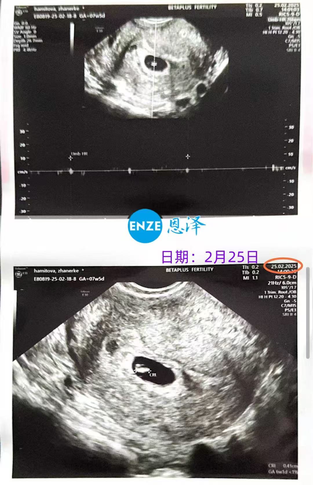 格鲁吉亚试管婴儿助孕爱心使者6周产检顺利通过