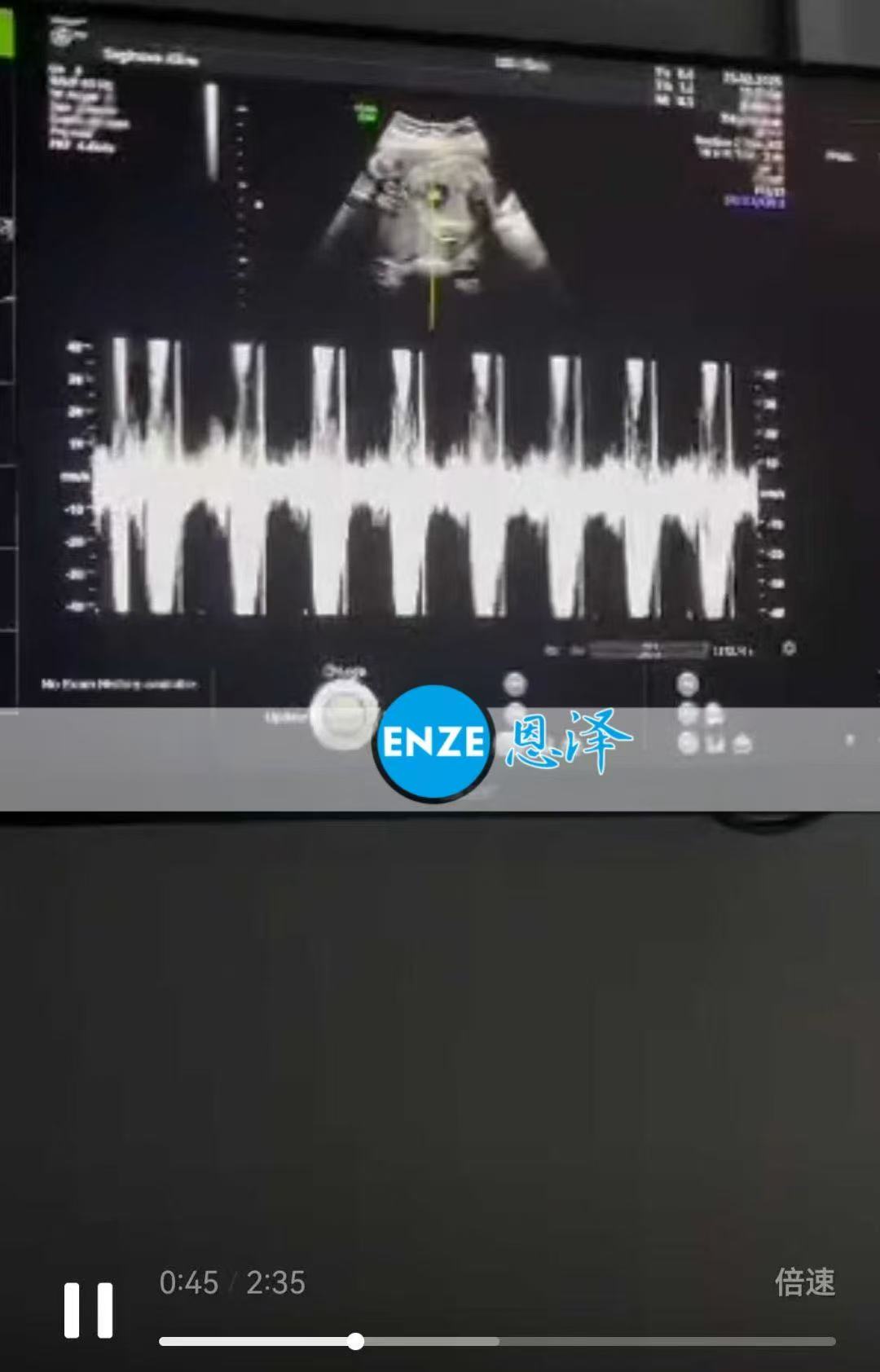 格鲁吉亚试管婴儿助孕爱心使者24周产检顺利通过