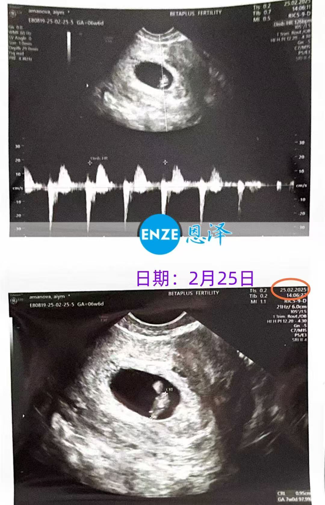 格鲁吉亚试管婴儿助孕爱心使者6周产检顺利通过