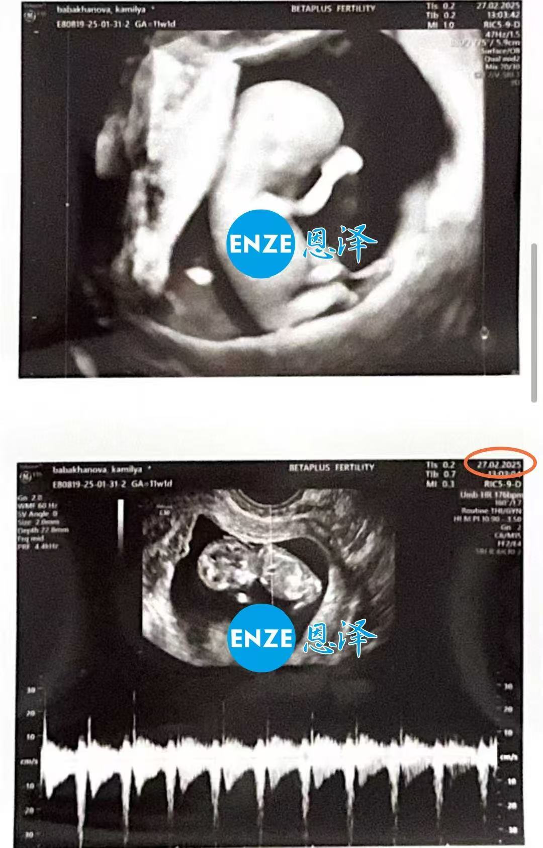 格鲁吉亚试管婴儿助孕爱心使者11周产检进展顺利