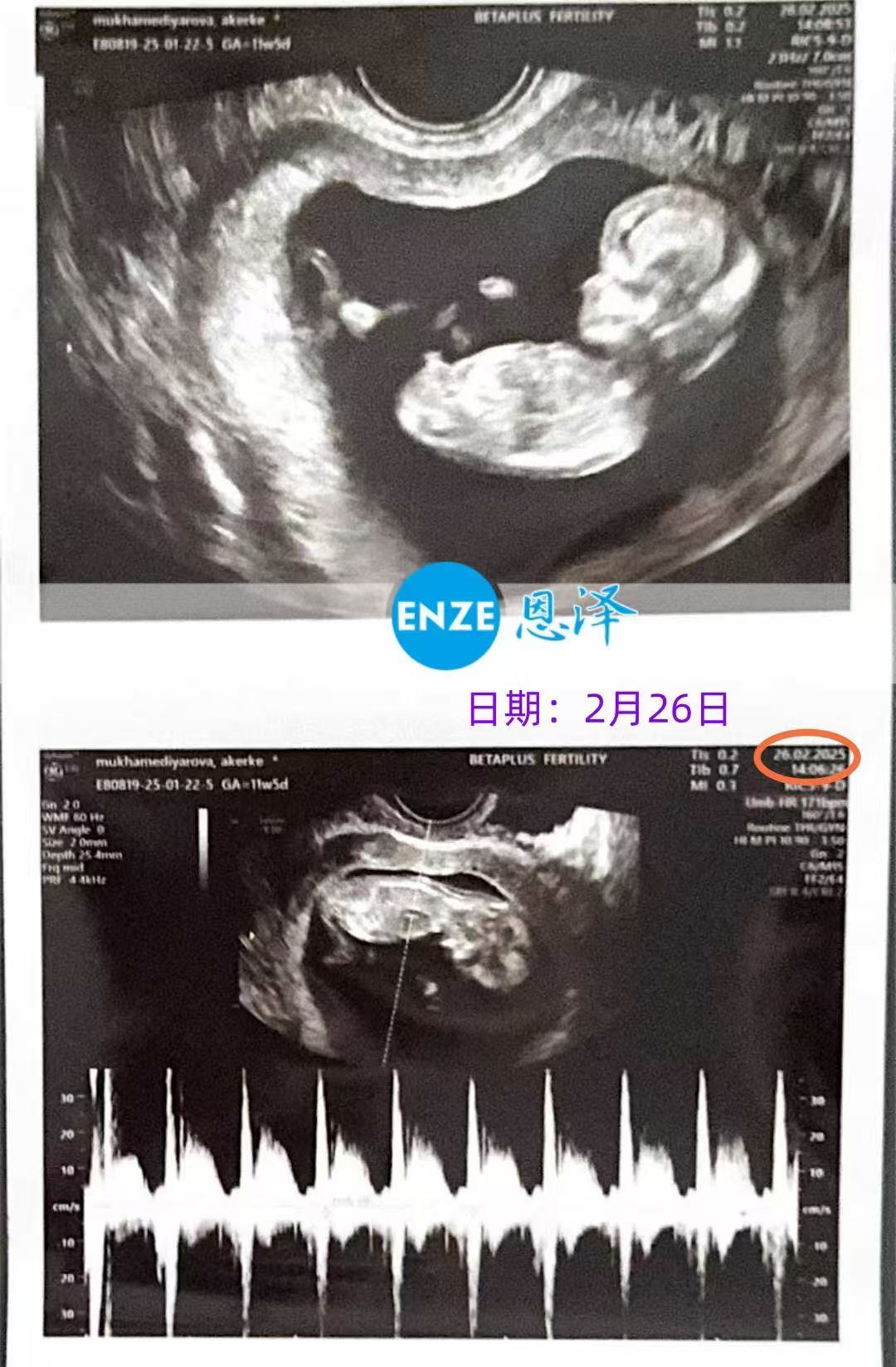 格鲁吉亚试管婴儿助孕爱心使者12周产检过关，正式度过风险期