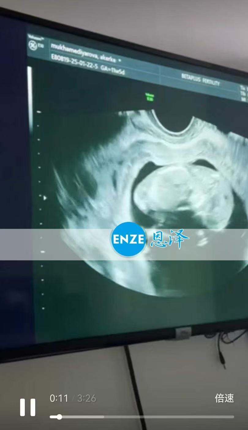 格鲁吉亚试管婴儿助孕爱心使者12周产检过关，正式度过风险期