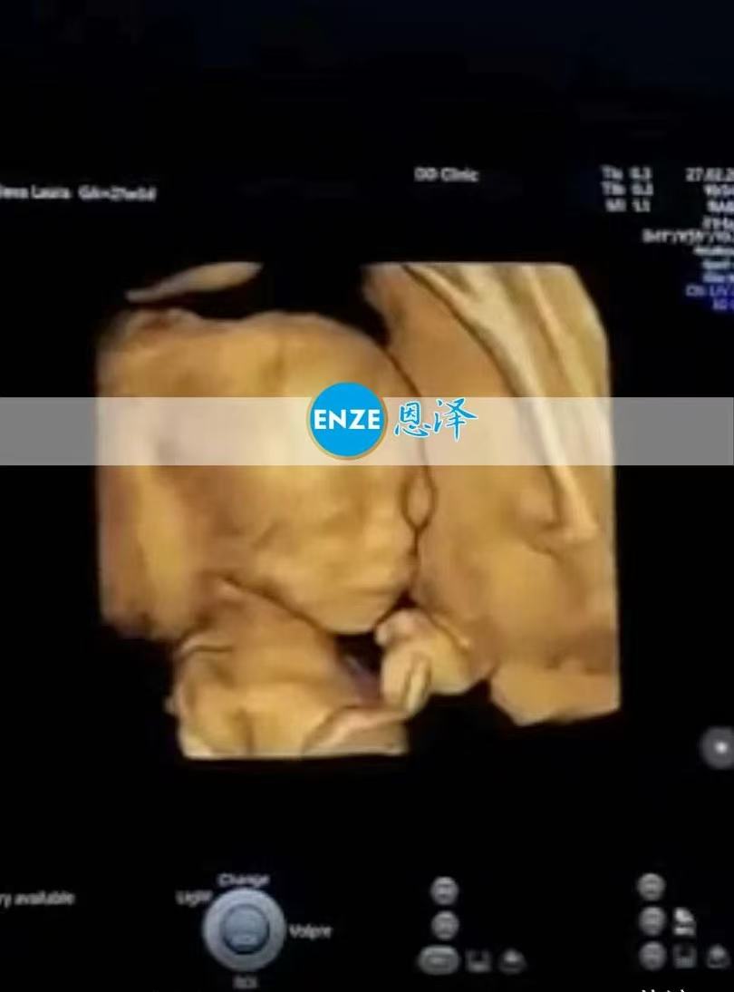 格鲁吉亚试管婴儿助孕爱心使者21周产检顺利通过