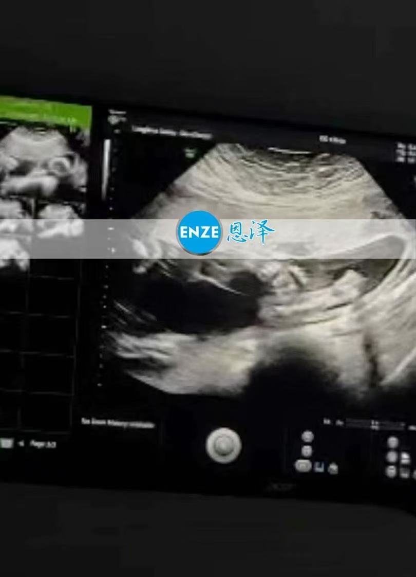 格鲁吉亚试管婴儿助孕爱心使者21周产检顺利通过
